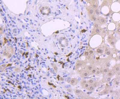Immunohistochemistry-Paraffin: S100A9 Antibody (JF096-8) [NBP2-67124] - Analysis of paraffin-embedded human liver cancer tissue using anti-S100A9 antibody. Counter stained with hematoxylin.