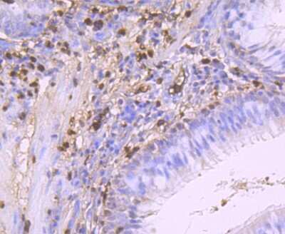 Immunohistochemistry-Paraffin: S100A9 Antibody (JF096-8) [NBP2-67124] - Analysis of paraffin-embedded human lung cancer tissue using anti-S100A9 antibody. Counter stained with hematoxylin.
