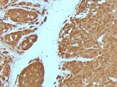 Immunohistochemistry-Paraffin: S100B Antibody (4C4.9 + S100B/1012) [NBP2-54559] - Formalin-fixed, paraffin-embedded human Melanoma stained with S100B Mouse Monoclonal Antibody (4C4.9 + S100B/1012)