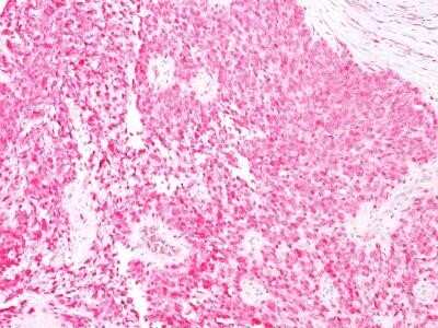 Immunohistochemistry-Paraffin: S100B Antibody (4C4.9) - Azide and BSA Free [NBP2-33168] - Formalin-fixed, paraffin-embedded human melanoma stained with S100 Ab (4C4.9).