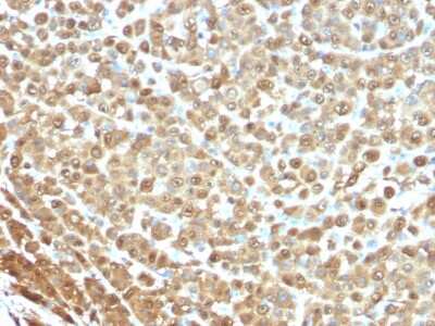 Immunohistochemistry-Paraffin: S100B Antibody (4C4.9) - Azide and BSA Free [NBP2-33168] - Formalin-fixed, paraffin-embedded human Melanoma stained with S100B Antibody (4C4.9)