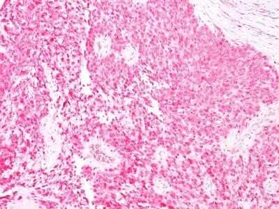 Immunohistochemistry-Paraffin: S100B Antibody (4C4.9) - IHC-Prediluted [NBP2-44590] - Formalin-fixed, paraffin-embedded human melanoma stained with S100 Ab (4C4.9).