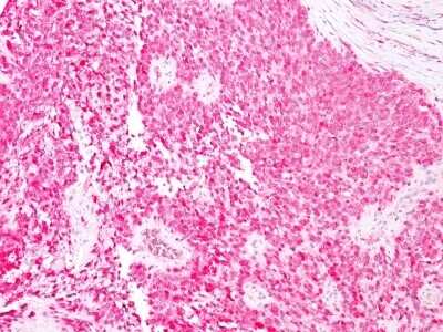 Immunohistochemistry-Paraffin: S100B Antibody (4C4.9) [NBP2-53179] - Formalin-fixed, paraffin-embedded human Melanoma stained with S100B Mouse Monoclonal Antibody (4C4.9) (AEC Chromogen)
