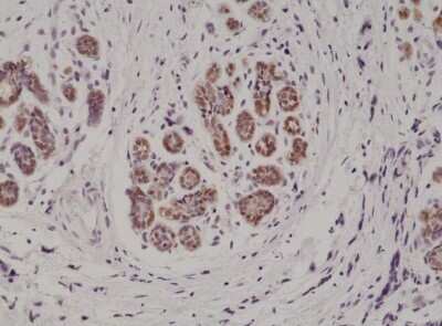 Immunohistochemistry-Paraffin: S100B Antibody (RM304) [NBP2-61585] - Immunohistochemical staining of formalin fixed and paraffin embedded human breast cancer tissue section using NBP2-61585.