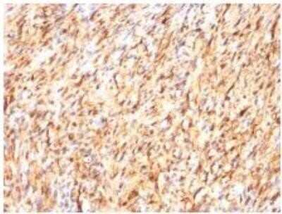 Immunohistochemistry-Paraffin: S100B Antibody (S100B/1012) - Azide and BSA Free [NBP2-59619] - Formalin-fixed, paraffin-embedded human Schwanoma stained with  S100B Mouse Monoclonal Antibody (S100B/1012).