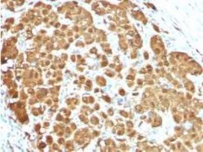 Immunohistochemistry-Paraffin: S100B Antibody (S100B/1012) - Azide and BSA Free [NBP2-59619] - Formalin-fixed. Paraffin-embedded human Melanoma stained with  S100B Mouse Monoclonal Antibody (S100B/1012).