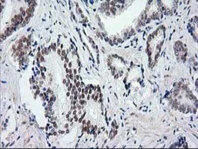 Immunohistochemistry: SAE2 Antibody (OTI4A3) - Azide and BSA Free [NBP2-73973] - Staining of paraffin-embedded Carcinoma of Human prostate tissue using anti-SAE2 mouse monoclonal antibody.