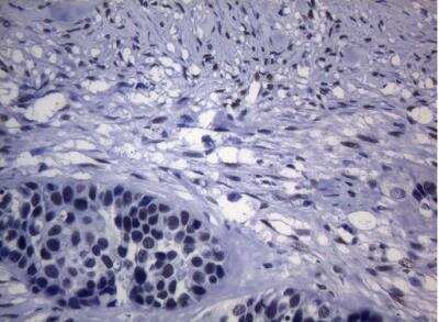Immunohistochemistry-Paraffin: SAMD12 Antibody (OTI2G1) [NBP2-45684] - Staining of paraffin-embedded Carcinoma of Human kidney tissue using anti-SAMD12 mouse monoclonal antibody.