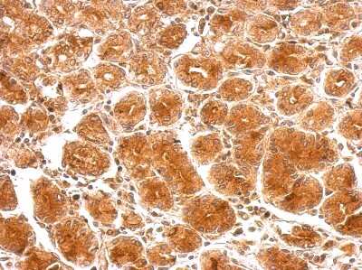 Immunohistochemistry-Paraffin: SAMD4B Antibody [NBP2-20255] - SAMD4B antibody detects SAMD4B protein at cytosol on colon carcinoma by immunohistochemical analysis. Sample: Paraffin-embedded colon carcinoma. SAMD4B antibody dilution: 1:500.