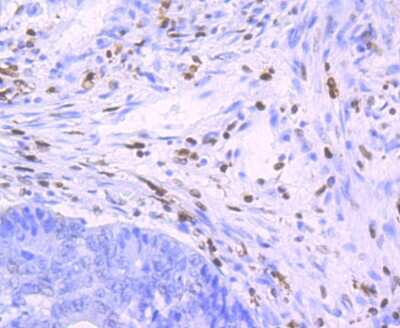Immunohistochemistry-Paraffin: SAMHD1 Antibody (JU56-04) [NBP2-75655] - Analysis of paraffin-embedded human colon cancer tissue using anti-SAMHD1 antibody. Counter stained with hematoxylin.