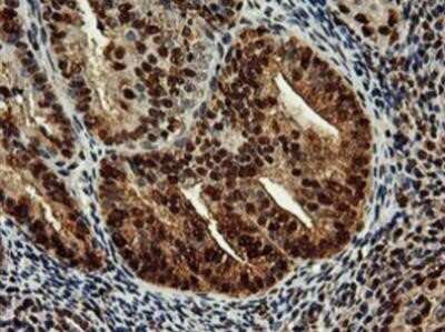 Immunohistochemistry: SAMHD1 Antibody (OTI3F5) - Azide and BSA Free [NBP2-73979] - Staining of paraffin-embedded Adenocarcinoma of Human endometrium tissue using anti-SAMHD1 mouse monoclonal antibody.