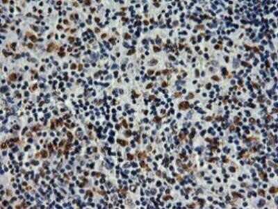 Immunohistochemistry: SAMHD1 Antibody (OTI3F5) - Azide and BSA Free [NBP2-73979] - Staining of paraffin-embedded Human lymphoma tissue using anti-SAMHD1 mouse monoclonal antibody.