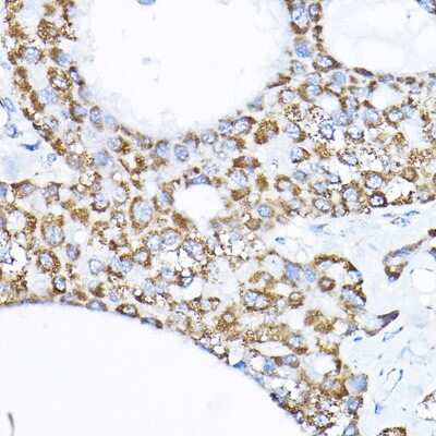 Immunohistochemistry-Paraffin: SAMM50 Antibody [NBP2-94852] - Immunohistochemistry of paraffin-embedded human liver cancer using SAMM50 Rabbit pAb (NBP2-94852) at dilution of 1:200 (40x lens). Perform high pressure antigen retrieval with 10 mM citrate buffer pH 6.0 before commencing with IHC staining protocol.