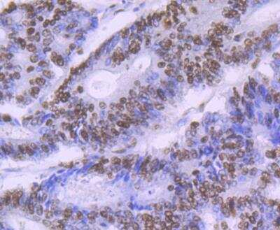 Immunohistochemistry: SAP130 Antibody (JG63-53) [NBP2-76869] - Immunohistochemical analysis of paraffin-embedded human colon cancer tissue using anti-SF3B3 antibody. Counter stained with hematoxylin.