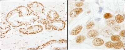 <b>Independent Antibodies Validation and Biological Strategies Validation.</b>Immunohistochemistry-Paraffin: SAP155 Antibody [NB100-55256] - Sample: FFPE section of human prostate carcinoma. Antibody: Affinity purified rabbit anti- SF3b155/SAP155 used at a dilution of 1:200 (1ug/ml). Detection: DAB