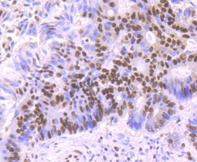 Immunohistochemistry-Paraffin: SAP155 Antibody (JB40-32) [NBP2-75656] - Analysis of paraffin-embedded human colon cancer tissue using anti-SF3B1 antibody. Counter stained with hematoxylin.