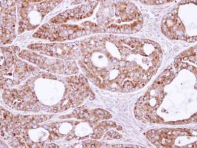 Immunohistochemistry-Paraffin: SAR1B Antibody [NBP1-32725] - Paraffin-embedded NCIN87 xenograft, using antibody at 1:500 dilution.