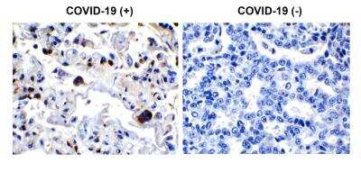 Immunohistochemistry-Paraffin: SARS-CoV-2 3CL Protease Antibody [NBP3-07062] - Immunohistochemical analysis of paraffin-embedded COVID-19 patient lung tissue using anti- SARS-CoV-2 3CL protease antibody (0.5 ug/mL). Tissue was fixed with formaldehyde and blocked with 10% serum for 1 h at RT; antigen retrieval was by heat mediation with a citrate buffer (pH6). Samples were incubated with primary antibody overnight at 4C. A goat anti-rabbit IgG H&L (HRP) at 1/250 was used as secondary. Counter stained with Hematoxylin. Strong signal of SARS-COV-2 3L-PRO (NSP5) protein was observed in macrophage of COVID-19 patient lung, but not in non-COVID-19 patient lung. 