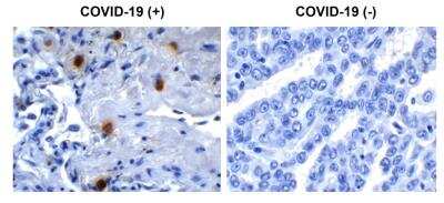 Immunohistochemistry-Paraffin: SARS-CoV-2 NSP10 Antibody [NBP3-07057] - Immunohistochemical analysis of paraffin-embedded COVID-19 patient lung tissue using anti- SARS-CoV-2 (COVID-19) NSP10 antibody (0.5 ug/mL). Tissue was fixed with formaldehyde and blocked with 10% serum for 1 h at RT; antigen retrieval was by heat mediation with a citrate buffer (pH6). Samples were incubated with primary antibody overnight at 4 degrees celsius. A goat anti-rabbit IgG H&L (HRP) at 1/250 was used as secondary. Counter stained with Hematoxylin. Strong signal of SARS-COV-2 NSP10 protein was observed in macrophage of COVID-19 patient lung, but not in non-COVID-19 patient lung.