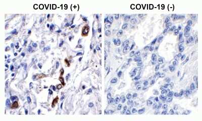 Immunohistochemistry-Paraffin: SARS-CoV-2 ORF3a Antibody [NBP3-11933] - Immunohistochemistry Validation of SARS-CoV-2 (COVID-19) ORF3a in COVID-19 Patient Lung Immunohistochemical analysis of paraffin-embedded COVID-19 patient lung tissue using anti- SARS-CoV-2 ORF3a antibody (NBP3-11933, 0.2 ug/mL). Tissue was fixed with formaldehyde and blocked with 10% serum for 1 h at RT; antigen retrieval was by heat mediation with a citrate buffer (pH6). Samples were incubated with primary antibody overnight at 4C. A goat anti-rabbit IgG H&L (HRP) at 1/250 was used as secondary. Counter stained with Hematoxylin. Strong signal of SARS-COV-2 ORF3a protein was observed in macrophages of COVID-19 patient lung, but not in non-COVID-19 patient lung.