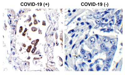 Immunohistochemistry-Paraffin: SARS-CoV-2 ORF8 Antibody [NBP3-11934] - Immunohistochemistry Validation of SARS-CoV-2 (COVID-19) ORF8 in COVID-19 Patient Lung Immunohistochemical analysis of paraffin-embedded COVID-19 patient lung tissue using anti- SARS-CoV-2 ORF8 antibody (NBP3-11934, 0.1 ug/mL). Tissue was fixed with formaldehyde and blocked with 10% serum for 1 h at RT; antigen retrieval was by heat mediation with a citrate buffer (pH6). Samples were incubated with primary antibody overnight at 4C. A goat anti-rabbit IgG H&L (HRP) at 1/250 was used as secondary. Counter stained with Hematoxylin. Strong signal of SARS-COV-2 ORF8 protein was observed in macrophages of COVID-19 patient lung, but not in non-COVID-19 patient lung.