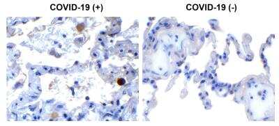 Immunohistochemistry: SARS-CoV-2 nsp13 Antibody [NBP3-07055] - Immunohistochemical analysis of paraffin-embedded COVID-19 patient lung tissue using anti- SARS-CoV-2 (COVID-19) NSP13 antibody (0.5 ug/mL). Tissue was fixed with formaldehyde and blocked with 10% serum for 1 h at RT; antigen retrieval was by heat mediation with a citrate buffer (pH6). Samples were incubated with primary antibody overnight at 4 degrees celsius. A goat anti-rabbit IgG H&L (HRP) at 1/250 was used as secondary. Counter stained with Hematoxylin. Strong signal of SARS-COV-2 NSP13 protein was observed in macrophage of COVID-19 patient lung, but not in non-COVID-19 patient lung.