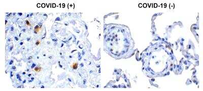 Immunohistochemistry: SARS-CoV-2 nsp14 Antibody [NBP3-07053] - Immunohistochemical analysis of paraffin-embedded COVID-19 patient lung tissue using anti- SARS-CoV-2 (COVID-19) NSP14 antibody (0.5 ug/mL). Tissue was fixed with formaldehyde and blocked with 10% serum for 1 h at RT; antigen retrieval was by heat mediation with a citrate buffer (pH6). Samples were incubated with primary antibody overnight at 4 degrees celsius. A goat anti-rabbit IgG H&L (HRP) at 1/250 was used as secondary. Counter stained with Hematoxylin. Strong signal of SARS-COV-2 NSP14 protein was observed in macrophage of COVID-19 patient lung, but not in non-COVID-19 patient lung.