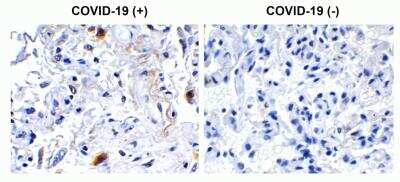 Immunohistochemistry: SARS-CoV-2 nsp2 Antibody [NBP3-07052] - Immunohistochemical analysis of paraffin-embedded COVID-19 patient lung tissue using anti- SARS-CoV-2 (COVID-19) NSP2 antibody (0.5 ug/mL). Tissue was fixed with formaldehyde and blocked with 10% serum for 1 h at RT; antigen retrieval was by heat mediation with a citrate buffer (pH6). Samples were incubated with primary antibody overnight at 4 degrees celcius. A goat anti-rabbit IgG H&L (HRP) at 1/250 was used as secondary. Counter stained with Hematoxylin. Strong signal of SARS-COV-2 NSP2 protein was observed in macrophage of COVID-19 patient lung, but not in non-COVID-19 patient lung.