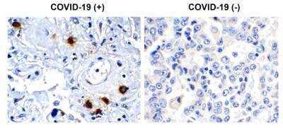 Immunohistochemistry: SARS-CoV-2 nsp7 Antibody [NBP3-07048] - Immunohistochemical analysis of paraffin-embedded COVID-19 patient lung tissue using anti- SARS-CoV-2 (COVID-19) NSP7 anbody (0.5 ug/mL). Tissue was fixed with formaldehyde and blocked with 10% serum for 1 h at RT; antigen retrieval was by heat mediation with a citrate buffer (pH6). Samples were incubated with primary antibody overnight at 4 degrees celsius. A goat anti-rabbit IgG H&L (HRP) at 1/250 was used as secondary. Counter stained with Hematoxylin. Strong signal of SARS-COV-2 NSP7 protein was observed in macrophage of COVID-19 patient lung, but not in non-COVID-19 patient lung.