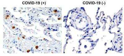 Immunohistochemistry: SARS-CoV-2 nsp8 Antibody [NBP3-07046] - Immunohistochemical analysis of paraffin-embedded COVID-19 patient lung tissue using anti- SARS-CoV-2 (COVID-19) NSP8 antibody (0.5 ug/mL). Tissue was fixed with formaldehyde and blocked with 10% serum for 1 h at RT; antigen retrieval was by heat mediation with a citrate buffer (pH6). Samples were incubated with primary antibody overnight at 4 degrees celsius. A goat anti-rabbit IgG H&L (HRP) at 1/250 was used as secondary. Counter stained with Hematoxylin. Strong signal of SARS-COV-2 NSP8 protein was observed in macrophage of COVID-19 patient lung, but not in non-COVID-19 patient lung.