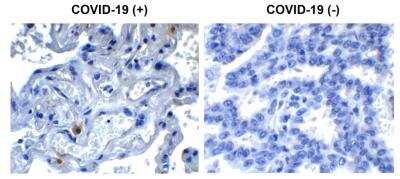 Immunohistochemistry: SARS-CoV-2 nsp9 Antibody [NBP3-07044] - Immunohistochemical analysis of paraffin-embedded COVID-19 patient lung tissue using anti- SARS-CoV-2 (COVID-19) NSP9 antibody (0.5 ug/mL). Tissue was fixed with formaldehyde and blocked with 10% serum for 1 h at RT; antigen retrieval was by heat mediation with a citrate buffer (pH6). Samples were incubated with primary antibody overnight at 4 degrees celsius. A goat anti-rabbit IgG H&L (HRP) at 1/250 was used as secondary. Counter stained with Hematoxylin. Strong signal of SARS-COV-2 NSP9 protein was observed in macrophage of COVID-19 patient lung, but not in non-COVID-19 patient lung.