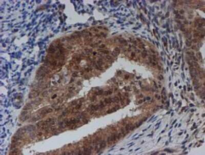 Immunohistochemistry-Paraffin: SAT2 Antibody (1C9) [NBP2-01998] - Staining of paraffin-embedded Adenocarcinoma of Human endometrium tissue using anti-SAT2 mouse monoclonal antibody.