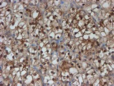 Immunohistochemistry-Paraffin: SAT2 Antibody (1C9) [NBP2-01998] - Staining of paraffin-embedded Carcinoma of Human kidney tissue using anti-SAT2 mouse monoclonal antibody.