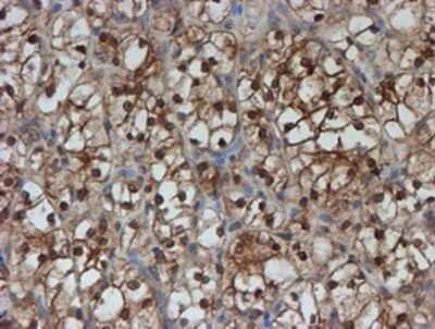 Immunohistochemistry: SAT2 Antibody (OTI1C9) - Azide and BSA Free [NBP2-73990] - Staining of paraffin-embedded Carcinoma of Human kidney tissue using anti-SAT2 mouse monoclonal antibody.