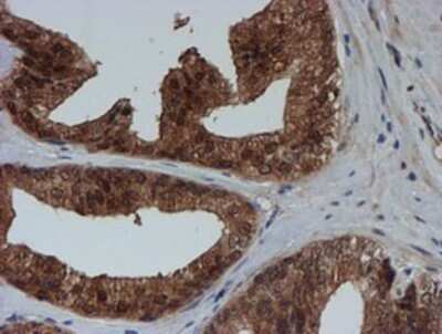 Immunohistochemistry: SAT2 Antibody (OTI1C9) - Azide and BSA Free [NBP2-73990] - Staining of paraffin-embedded Carcinoma of Human prostate tissue using anti-SAT2 mouse monoclonal antibody.