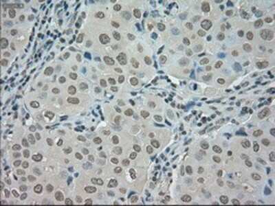 Immunohistochemistry-Paraffin: SATB1 Antibody (13D6) [NBP1-47950] - Staining of paraffin-embedded Adenocarcinoma of breast tissue using anti-SATB1 mouse monoclonal antibody.