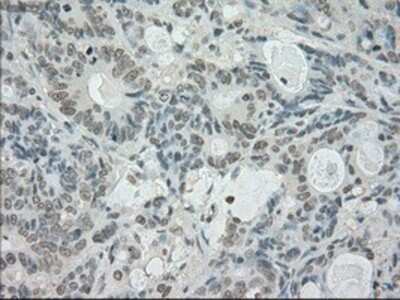 Immunohistochemistry-Paraffin: SATB1 Antibody (13D6) [NBP1-47950] - Staining of paraffin-embedded Adenocarcinoma of colon tissue using anti-SATB1 mouse monoclonal antibody.