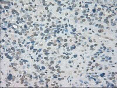 Immunohistochemistry-Paraffin: SATB1 Antibody (13D6) [NBP1-47950] - Staining of paraffin-embedded Carcinoma of bladder tissue using anti-SATB1 mouse monoclonal antibody.