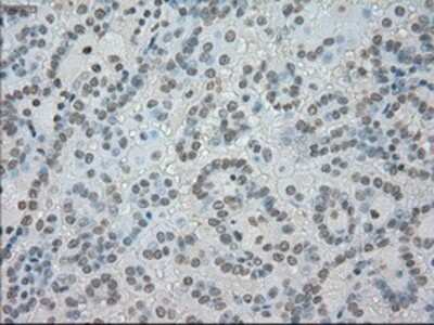 Immunohistochemistry-Paraffin: SATB1 Antibody (13D6) [NBP1-47950] - Staining of paraffin-embedded Carcinoma of kidney tissue using anti-SATB1 mouse monoclonal antibody.