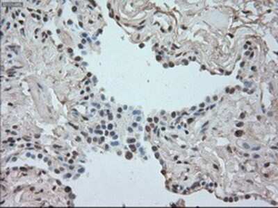 Immunohistochemistry-Paraffin: SATB1 Antibody (13D6) [NBP1-47950] - Staining of paraffin-embedded Carcinoma of lung tissue using anti-SATB1 mouse monoclonal antibody.