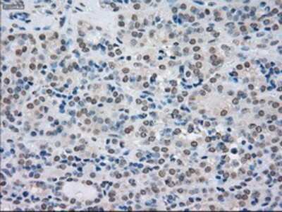 Immunohistochemistry-Paraffin: SATB1 Antibody (13D6) [NBP1-47950] - Staining of paraffin-embedded Carcinoma of thyroid tissue using anti-SATB1 mouse monoclonal antibody.