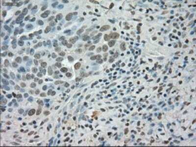 Immunohistochemistry: SATB1 Antibody (OTI13D6) - Azide and BSA Free [NBP2-73991] - Staining of paraffin-embedded Adenocarcinoma of ovary tissue using anti-SATB1 mouse monoclonal antibody.