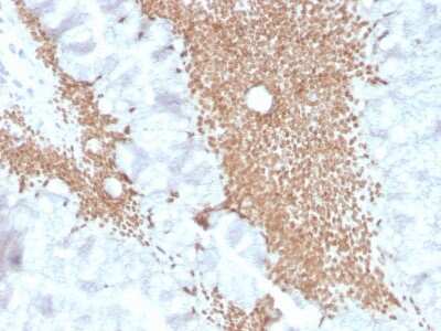 Immunohistochemistry-Paraffin: SATB2 Antibody (SATB2/4374R) - Azide and BSA Free [NBP3-08808] - Formalin-fixed, paraffin-embedded human colon carcinoma stained with SATB2 Rabbit Recombinant Monoclonal Antibody (SATB2/4374R).
