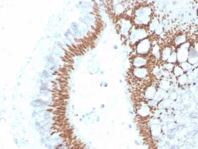 Immunohistochemistry-Paraffin: SATB2 Antibody (SATB2/4374R) - Azide and BSA Free [NBP3-08808] - Formalin-fixed, paraffin-embedded human colon carcinoma stained with SATB2 Rabbit Recombinant Monoclonal Antibody (SATB2/4374R).