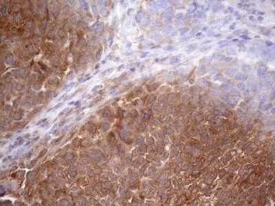 Immunohistochemistry: SCFD1 Antibody (10D8) [NBP2-45708] - Analysis of Adenocarcinoma of Human ovary tissue. (Heat-induced epitope retrieval by 1mM EDTA in 10mM Tris buffer (pH8.5) at 120 oC for 3 min)