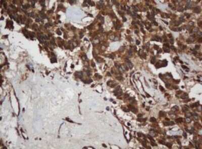 Immunohistochemistry: SCFD1 Antibody (4D2) [NBP2-45707] - Analysis of Carcinoma of Human pancreas tissue. (Heat-induced epitope retrieval by 10mM citric buffer, pH6.0, 120C for 3min)