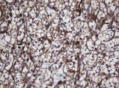 Immunohistochemistry: SCFD1 Antibody (4D2) [NBP2-45707] - Analysis of Carcinoma of Human kidney tissue. (Heat-induced epitope retrieval by 10mM citric buffer, pH6.0, 120C for 3min)