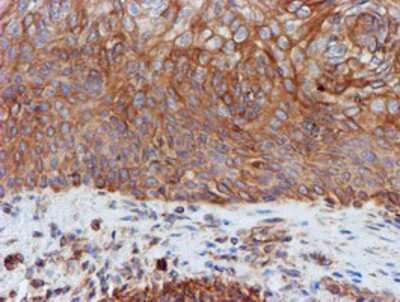 Immunohistochemistry-Paraffin: SCFD1 Antibody (5G4) [NBP2-02031] - Staining of paraffin-embedded Carcinoma of Human bladder tissue using anti-SCFD1 mouse monoclonal antibody.