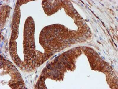 Immunohistochemistry-Paraffin: SCFD1 Antibody (5G4) [NBP2-02031] - Staining of paraffin-embedded Carcinoma of Human prostate tissue using anti-SCFD1 mouse monoclonal antibody.