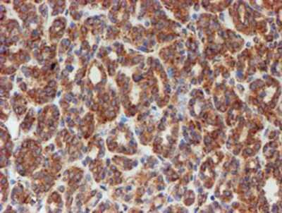 Immunohistochemistry-Paraffin: SCFD1 Antibody (5G4) [NBP2-02031] - Staining of paraffin-embedded Carcinoma of Human thyroid tissue using anti-SCFD1 mouse monoclonal antibody.